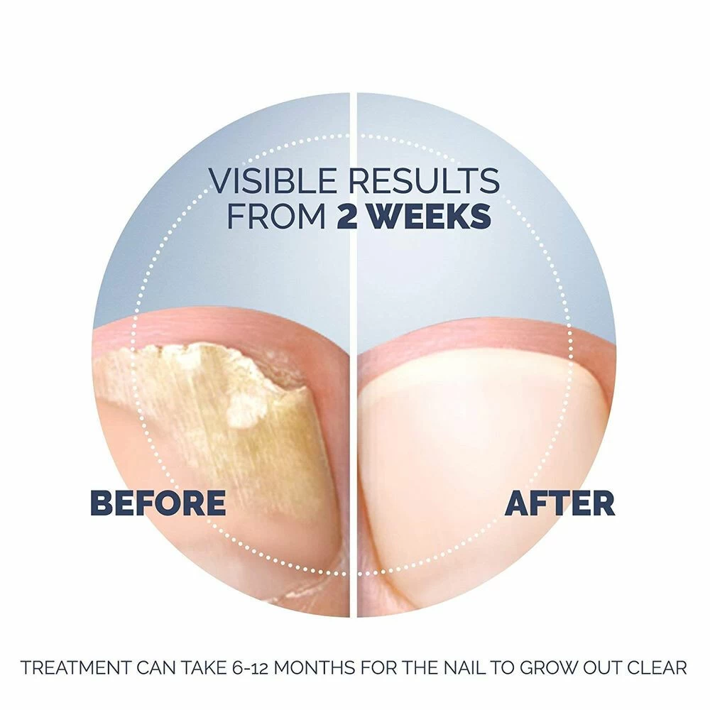 Scholl Kalknagel Behandelset - Afbeelding 6